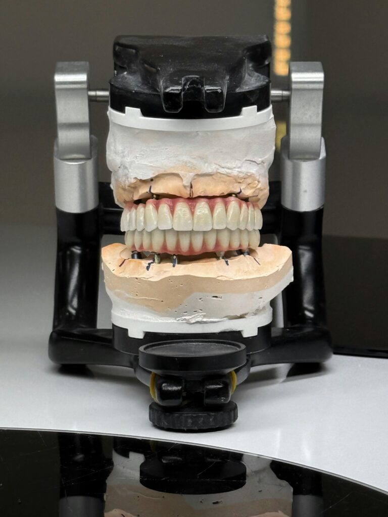 Dental Implants: Everything You Need to Know Before Choosing