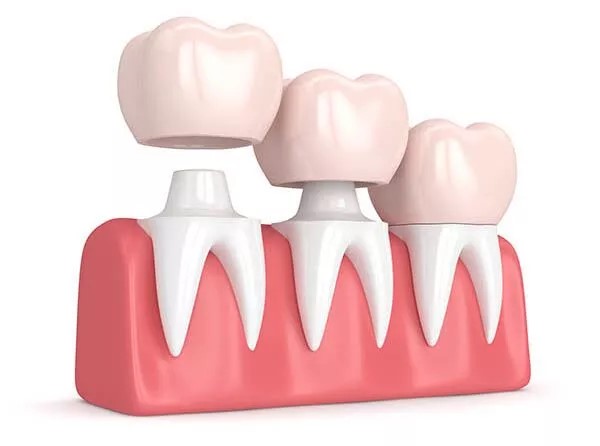 Dental Crowns